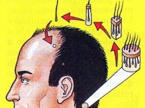 Perdita di capelli alopetion omeopatia